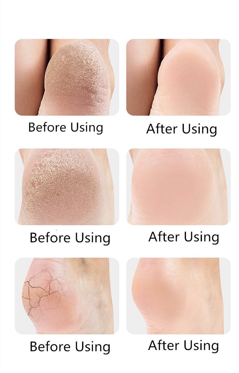 זוג פדים מסיליקון למניעת עור יבש וכאבים בכף הרגל