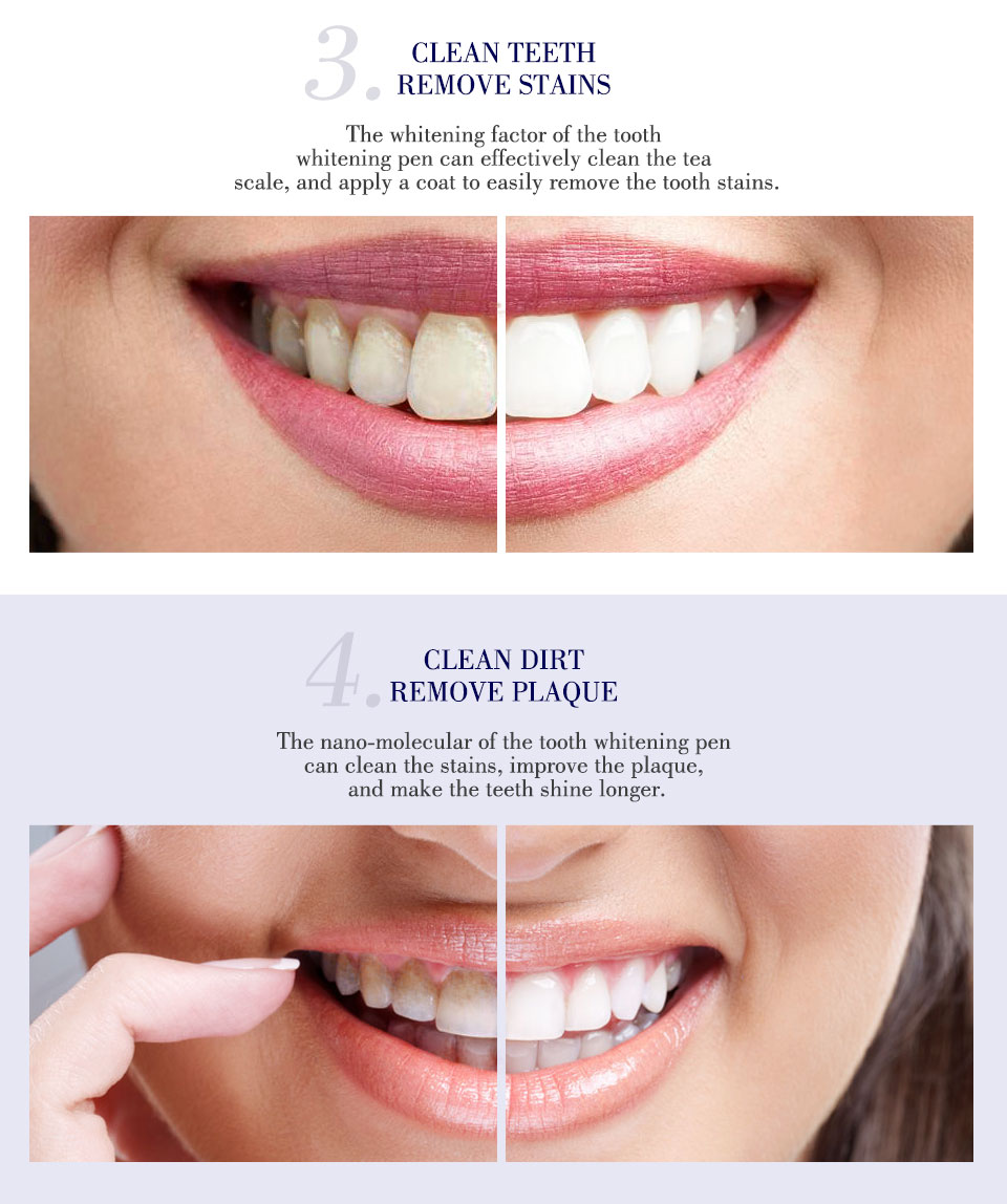 עט להלבנת שיניים ibcccndc