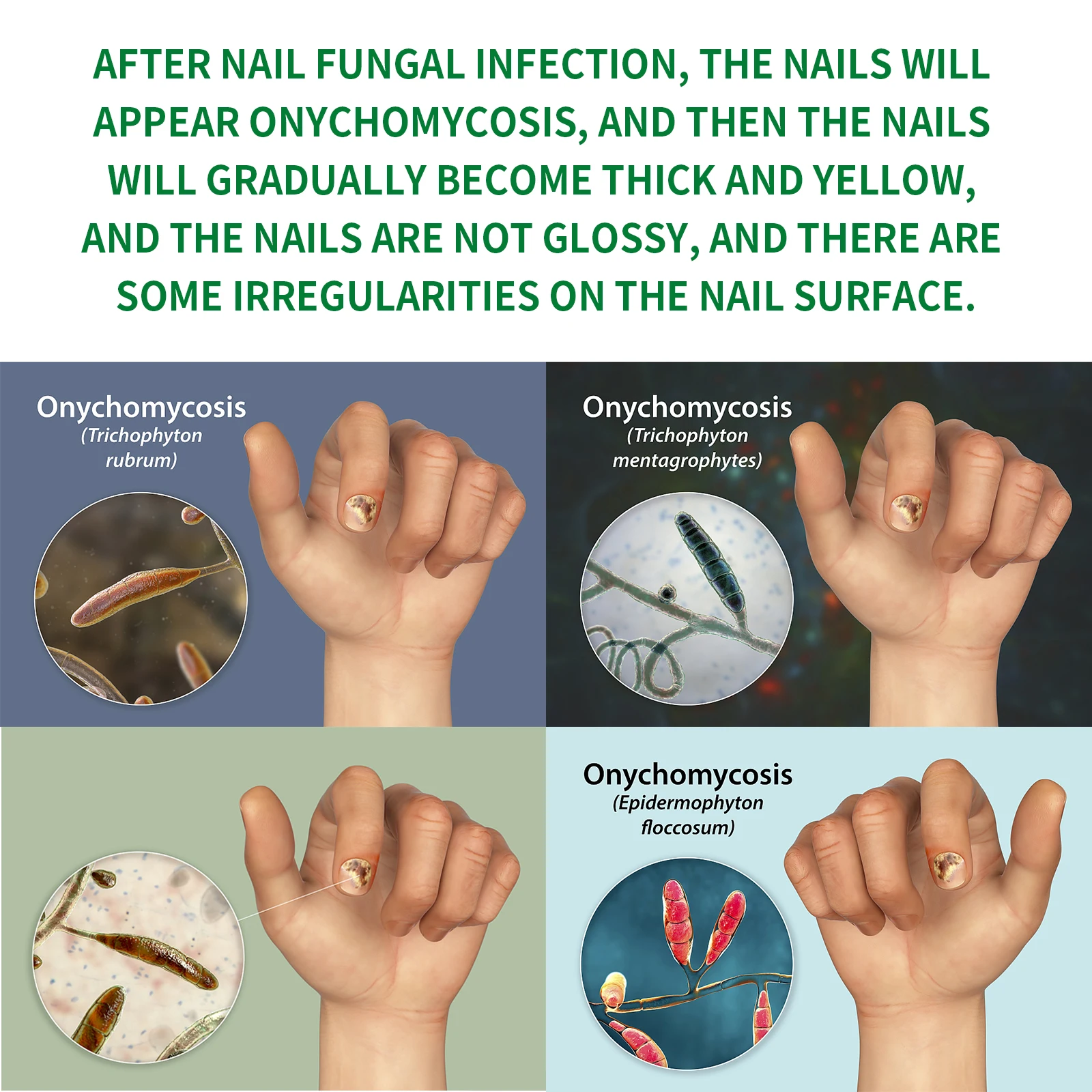 Nail Fungal Treatment Essential Oil Nail Fungus Removal Serum Foot Toe Onychomycosis Repair