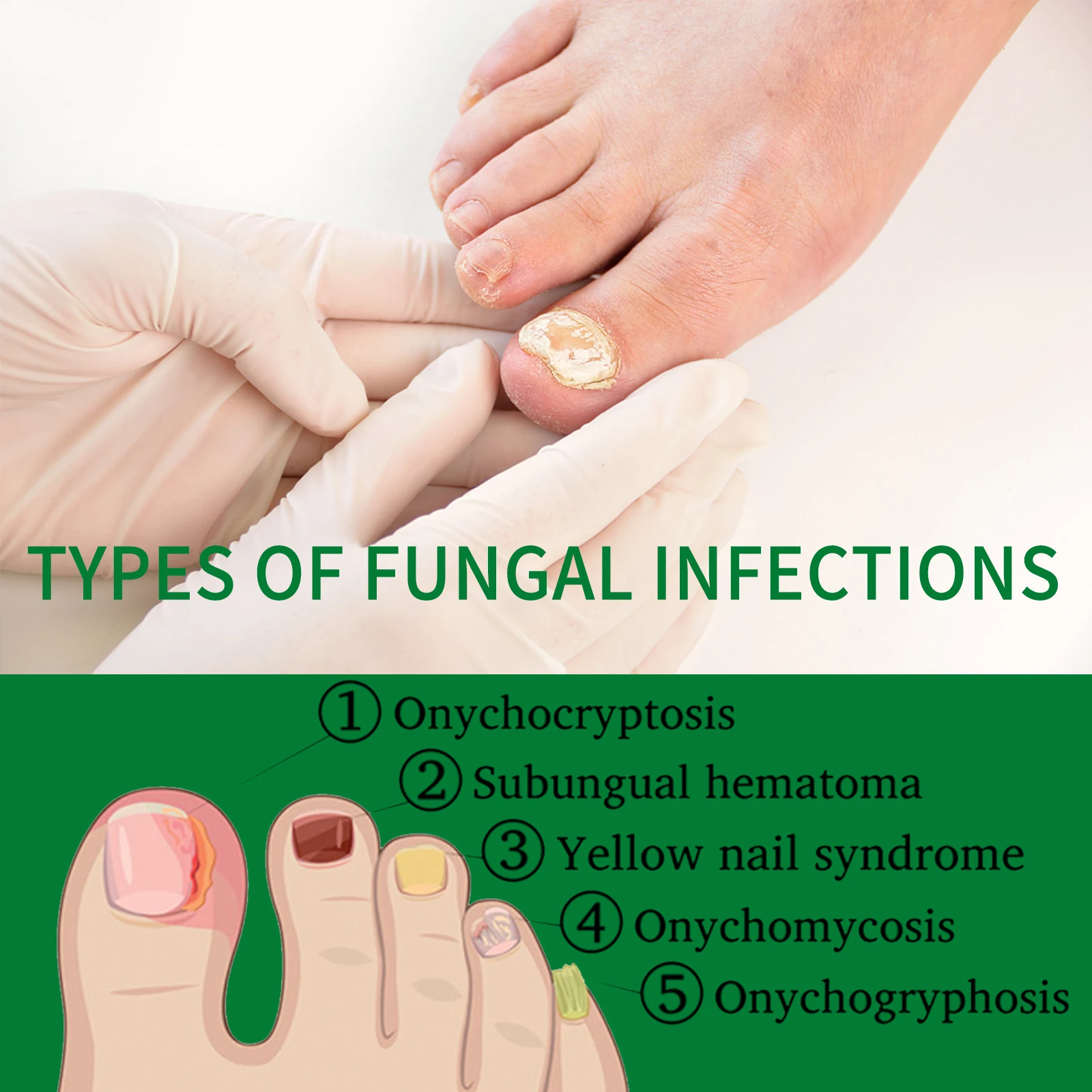 Nail Fungal Treatment Essential Oil Nail Fungus Removal Serum Foot Toe Onychomycosis Repair