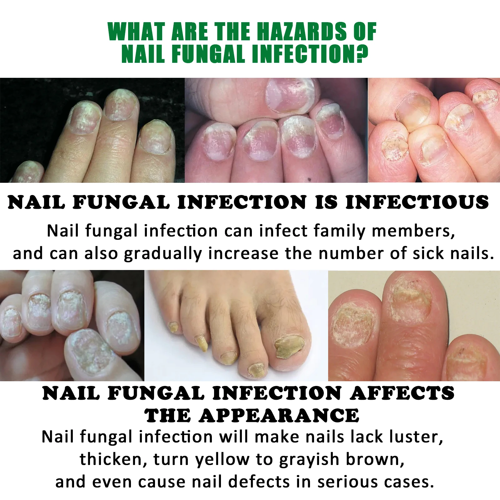 Nail Fungal Treatment Essential Oil Nail Fungus Removal Serum Foot Toe Onychomycosis Repair